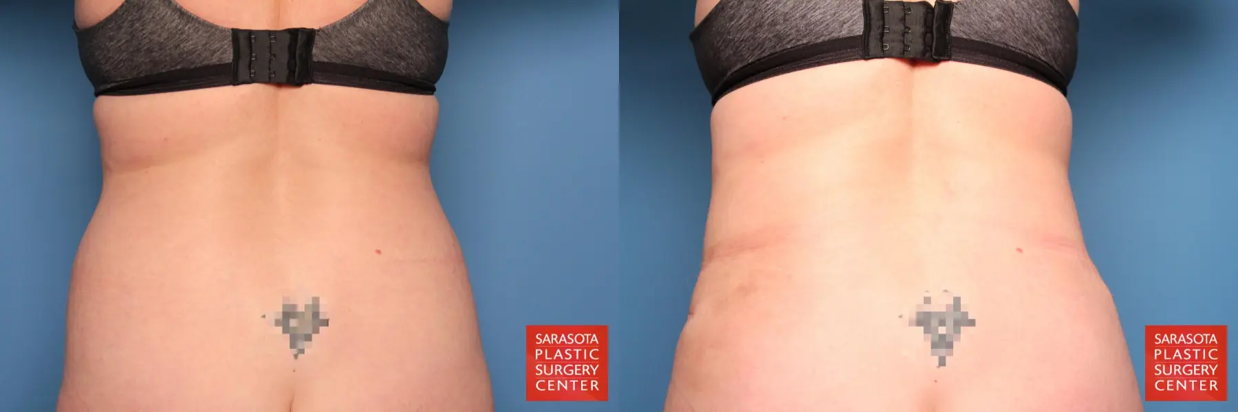 Tummy Tuck: Patient 11 - Before and After 5