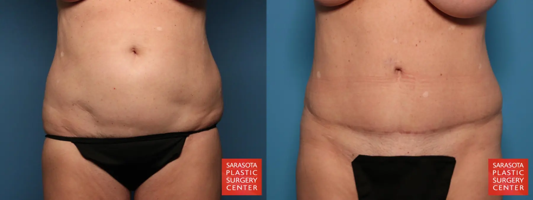 Tummy Tuck: Patient 19 - Before and After 1