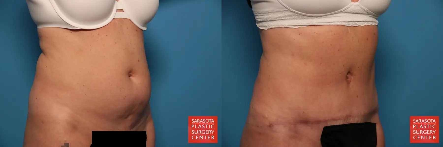 Tummy Tuck: Patient 22 - Before and After 2