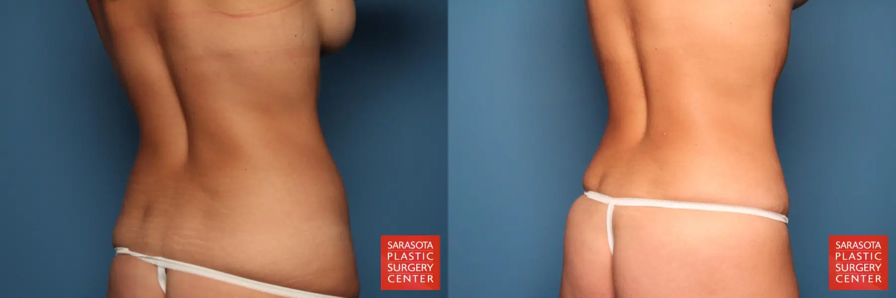 Tummy Tuck: Patient 9 - Before and After 6
