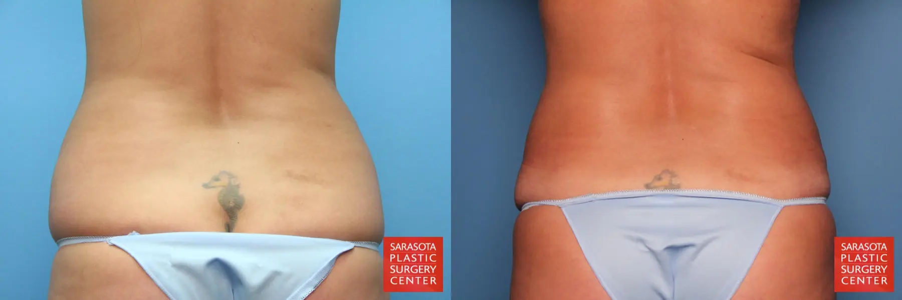 Tummy Tuck: Patient 12 - Before and After 5