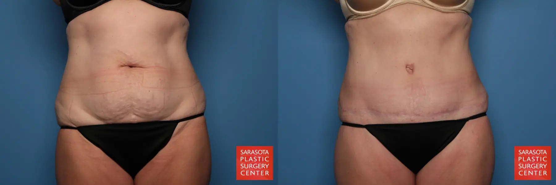 Tummy Tuck: Patient 18 - Before and After  