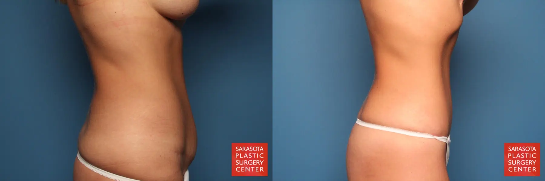 Tummy Tuck: Patient 9 - Before and After 7