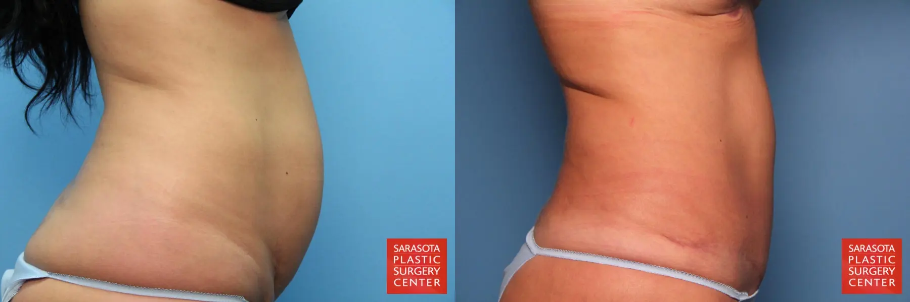 Tummy Tuck: Patient 12 - Before and After 7
