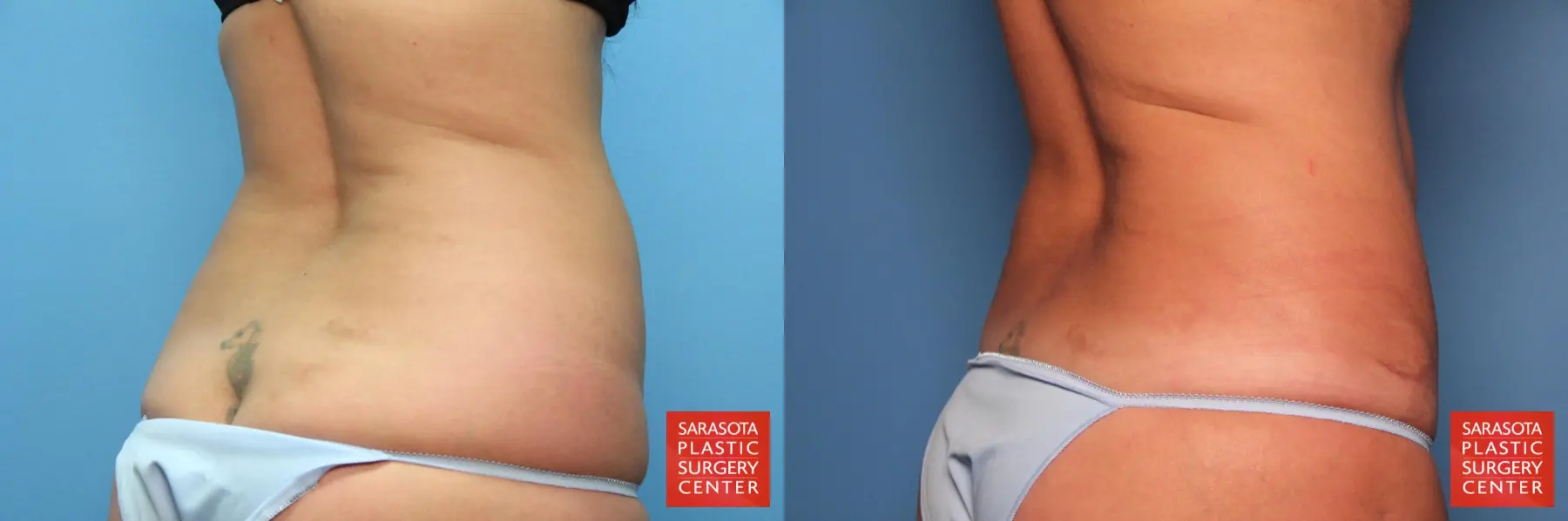 Tummy Tuck: Patient 12 - Before and After 6