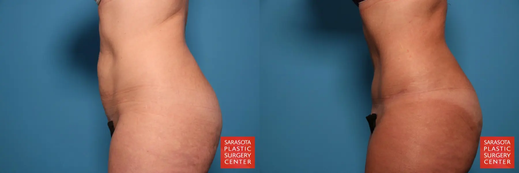 Tummy Tuck: Patient 2 - Before and After 3