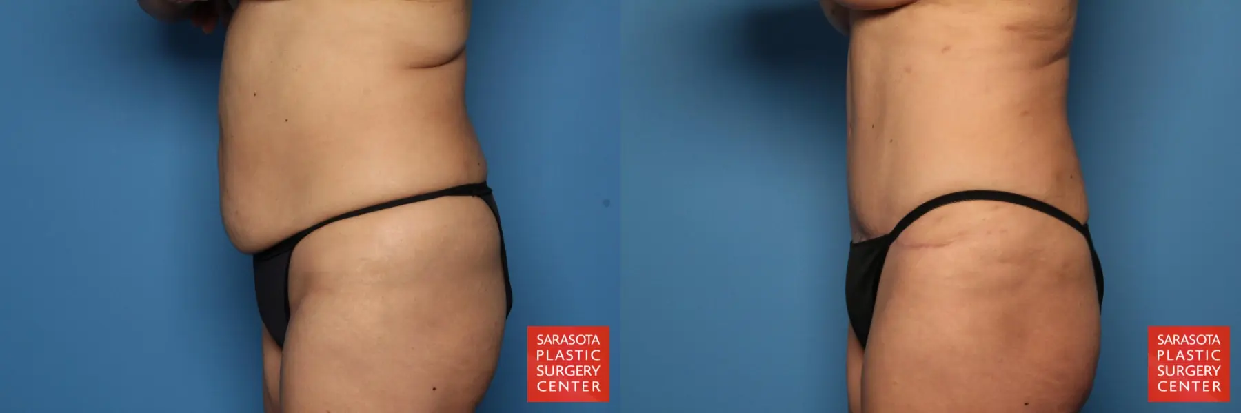 Tummy Tuck: Patient 4 - Before and After 3