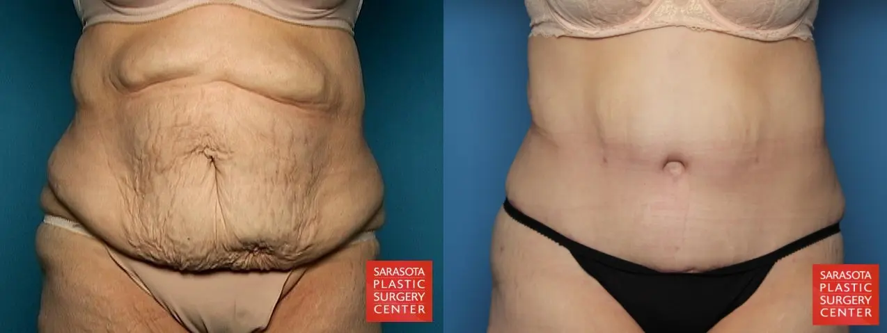 Tummy Tuck: Patient 2 - Before and After 1