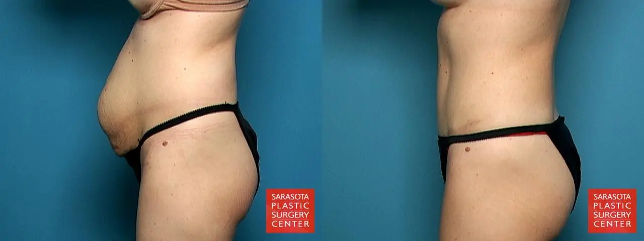 Tummy Tuck: Patient 6 - Before and After 3