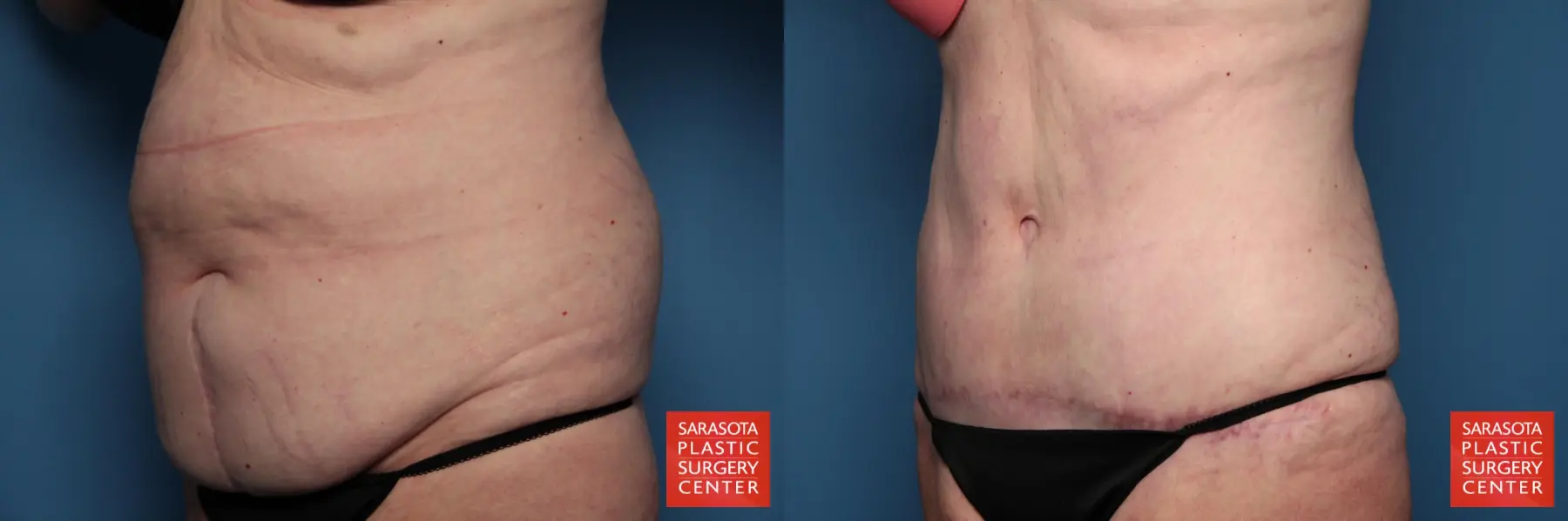 Tummy Tuck: Patient 15 - Before and After 3