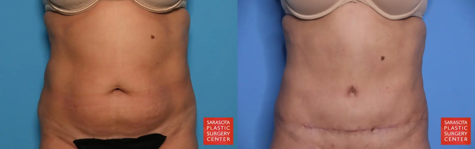 Tummy Tuck: Patient 31 - Before and After 1
