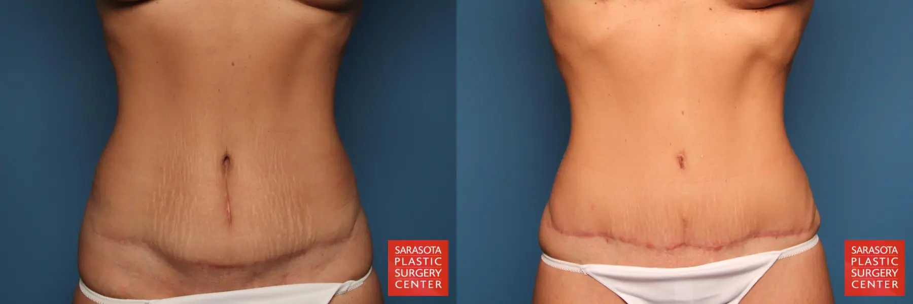 Tummy Tuck: Patient 9 - Before and After  