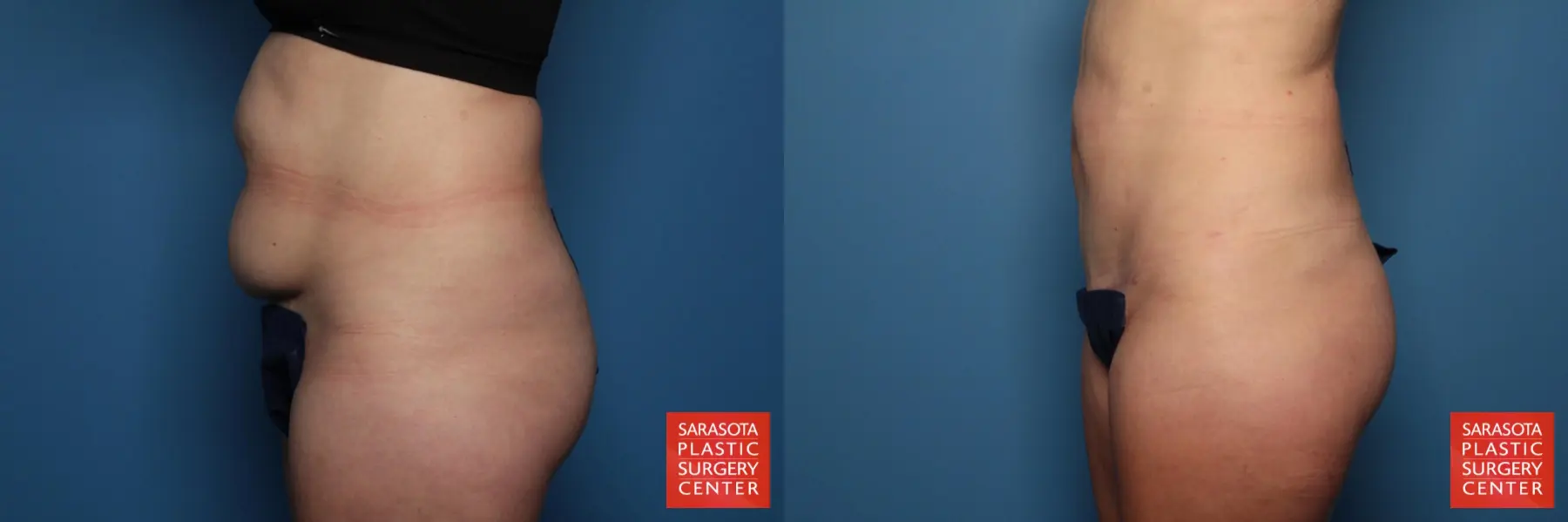 Tummy Tuck: Patient 5 - Before and After 3