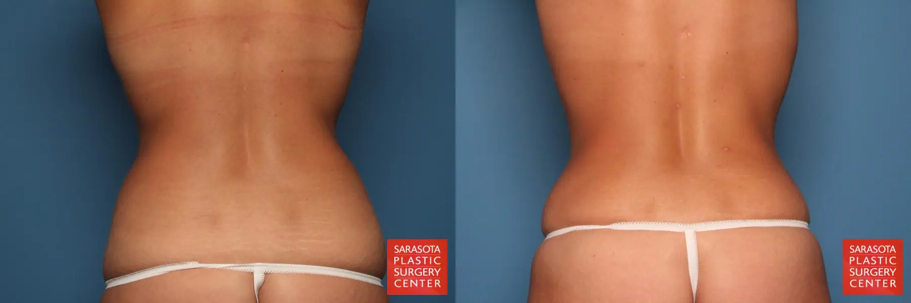 Tummy Tuck: Patient 9 - Before and After 5