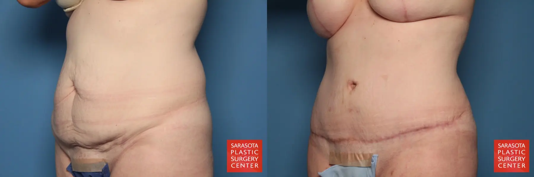 Tummy Tuck: Patient 17 - Before and After 2