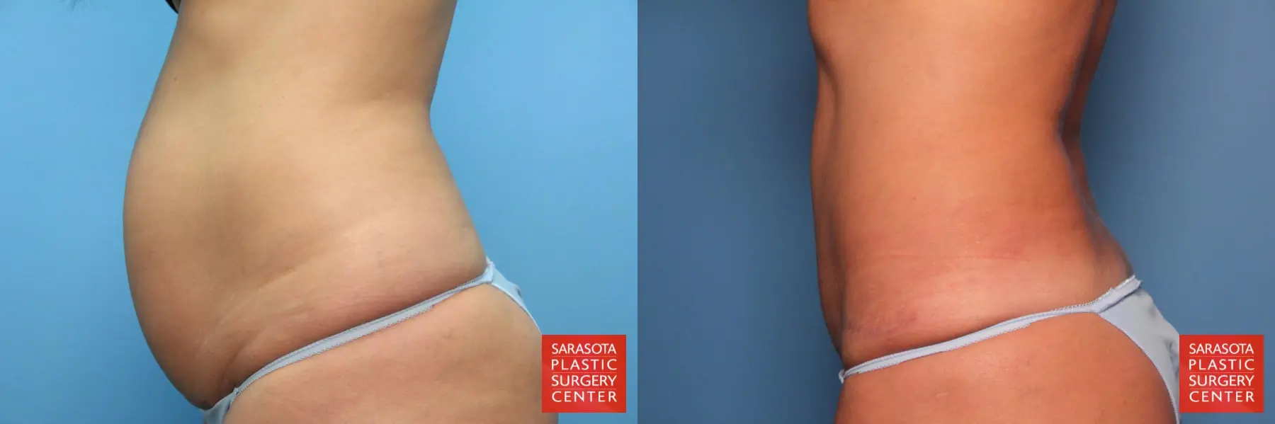 Tummy Tuck: Patient 12 - Before and After 3