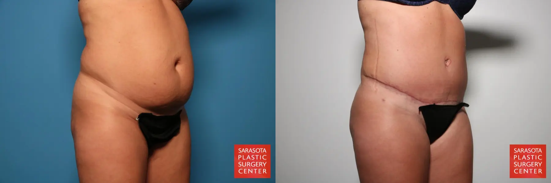 Tummy Tuck: Patient 24 - Before and After 2