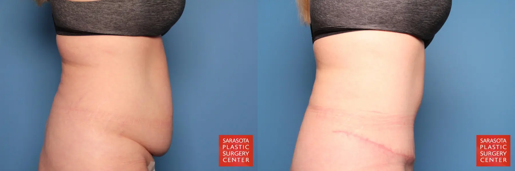 Tummy Tuck: Patient 11 - Before and After 7