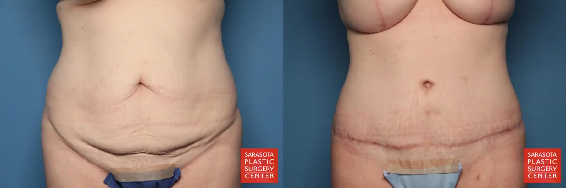 Tummy Tuck: Patient 17 - Before and After  