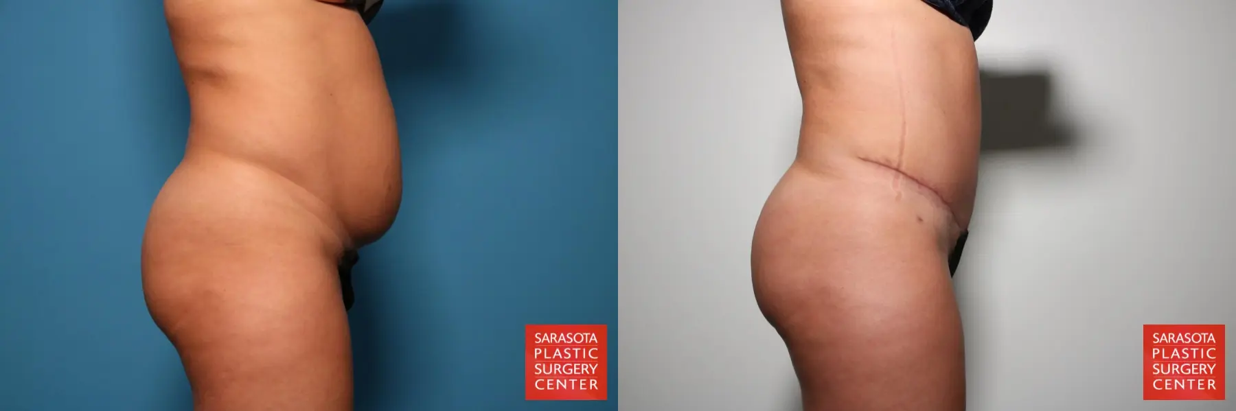 Tummy Tuck: Patient 24 - Before and After 3