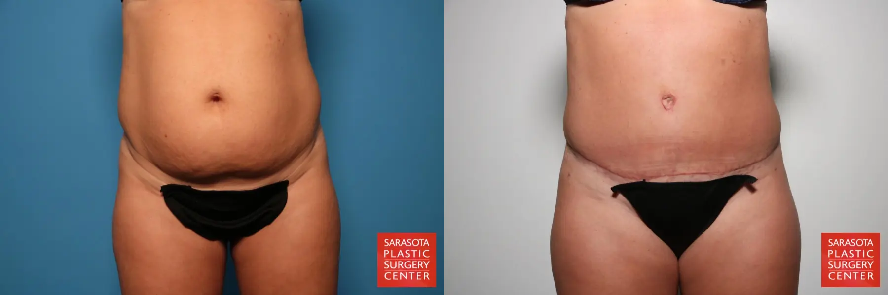 Tummy Tuck: Patient 23 - Before and After  