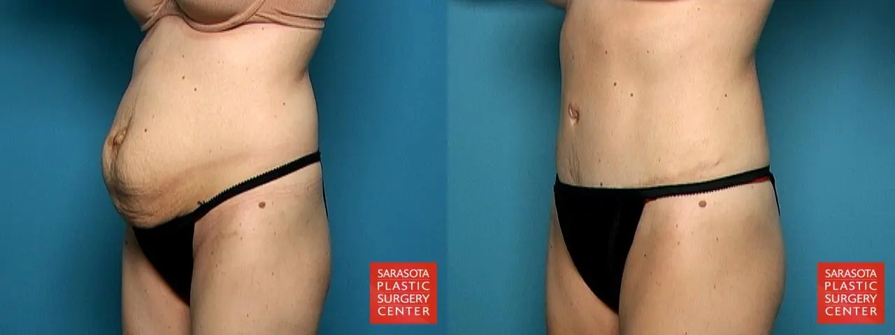 Tummy Tuck: Patient 6 - Before and After 2