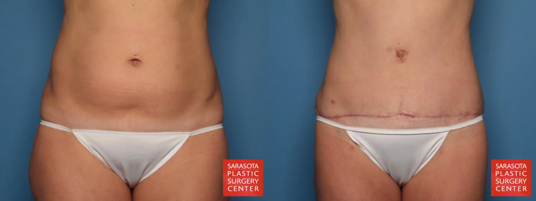 Tummy Tuck: Patient 20 - Before and After 1