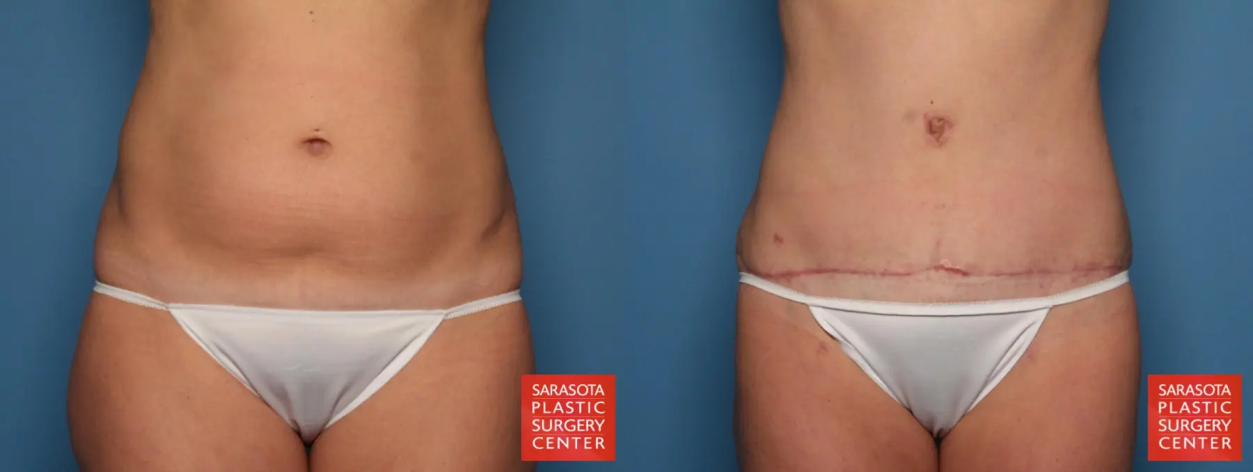 Tummy Tuck: Patient 20 - Before and After  