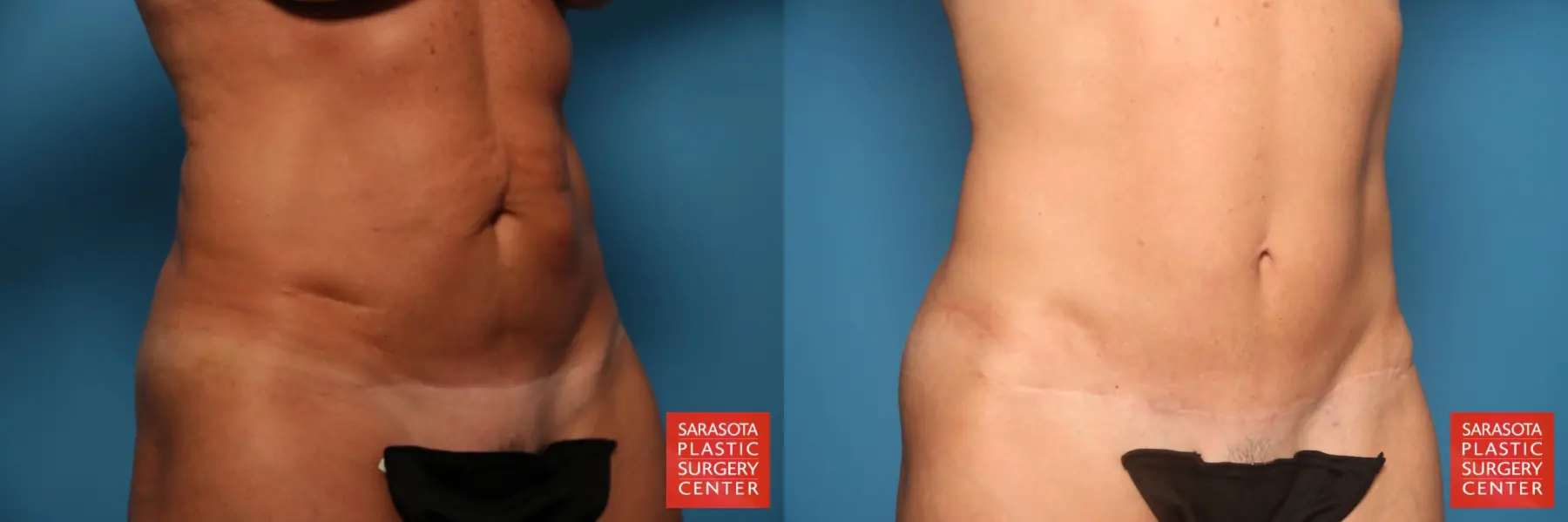 Tummy Tuck: Patient 28 - Before and After 4