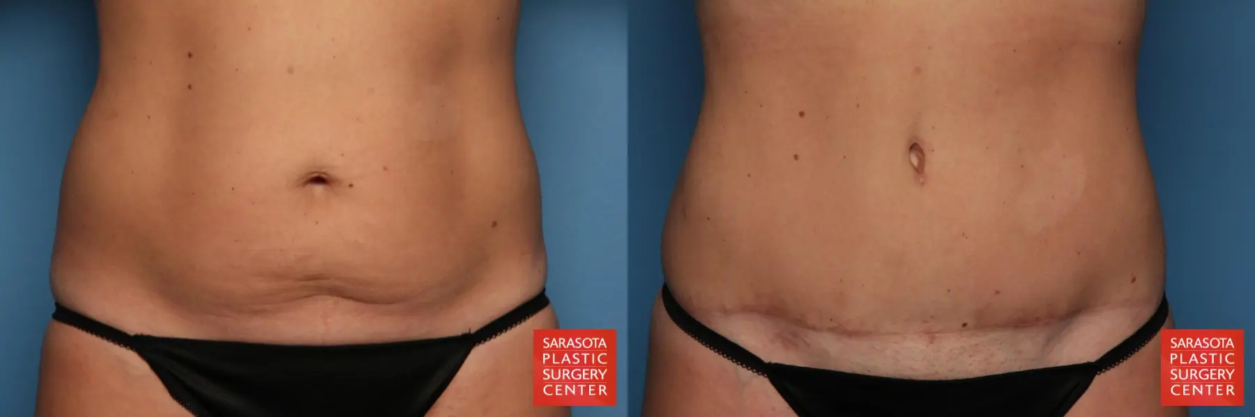 Tummy Tuck: Patient 8 - Before and After  