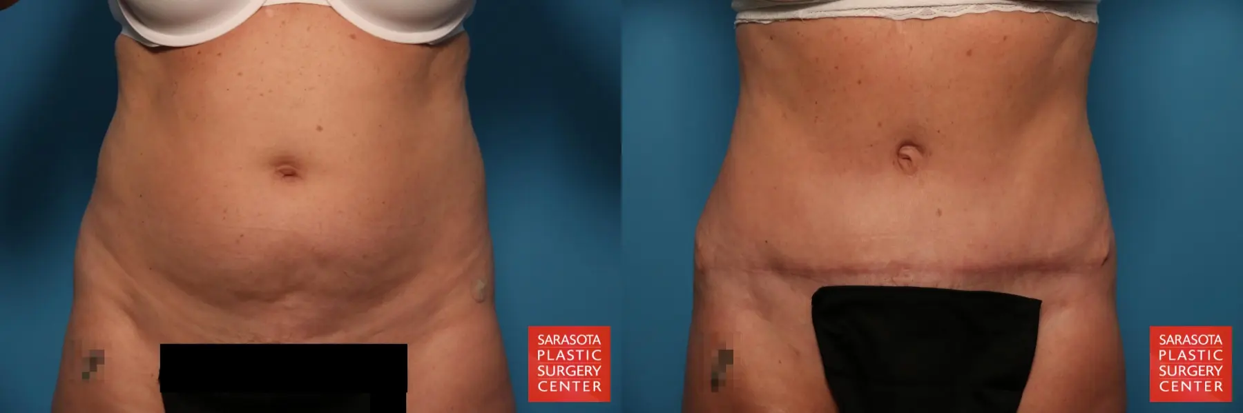 Tummy Tuck: Patient 21 - Before and After  