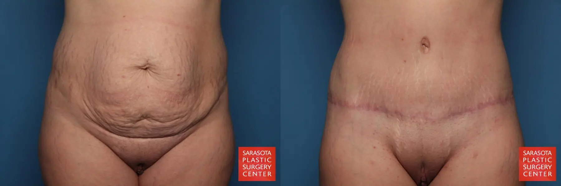 Tummy Tuck: Patient 21 - Before and After 1