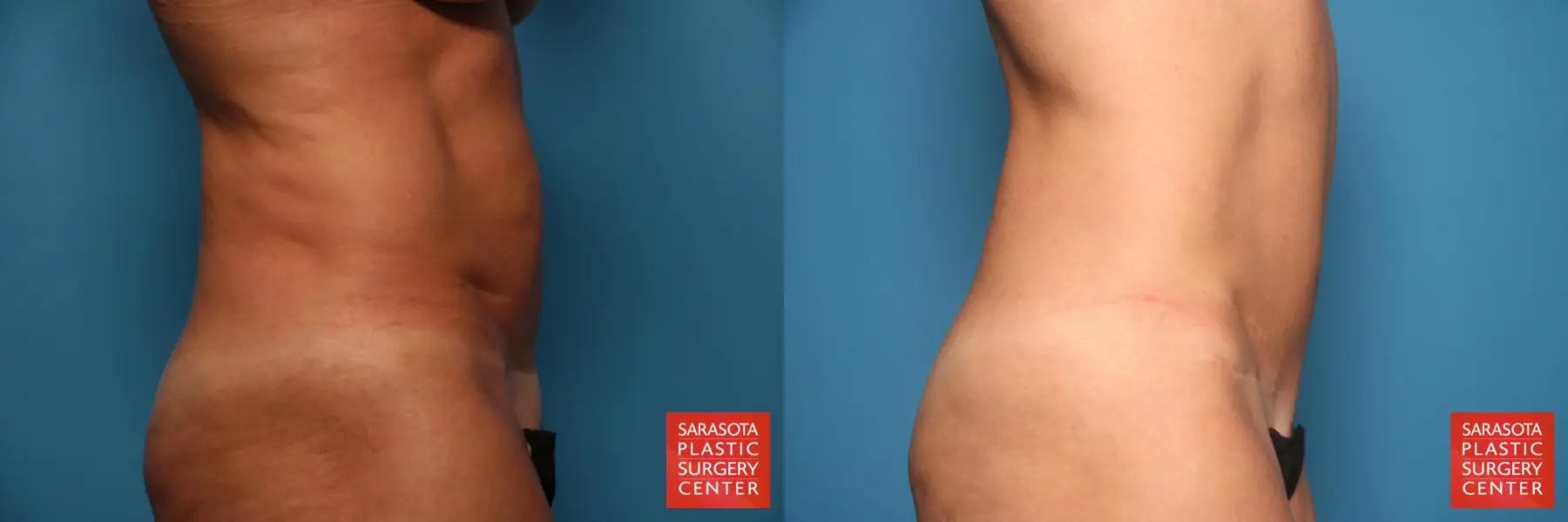 Tummy Tuck: Patient 28 - Before and After 5