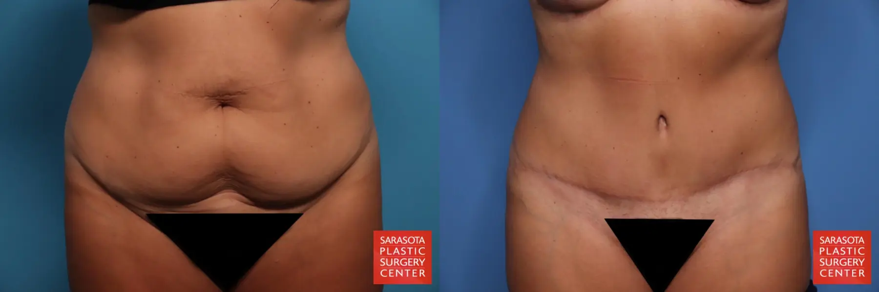 Tummy Tuck: Patient 27 - Before and After 1