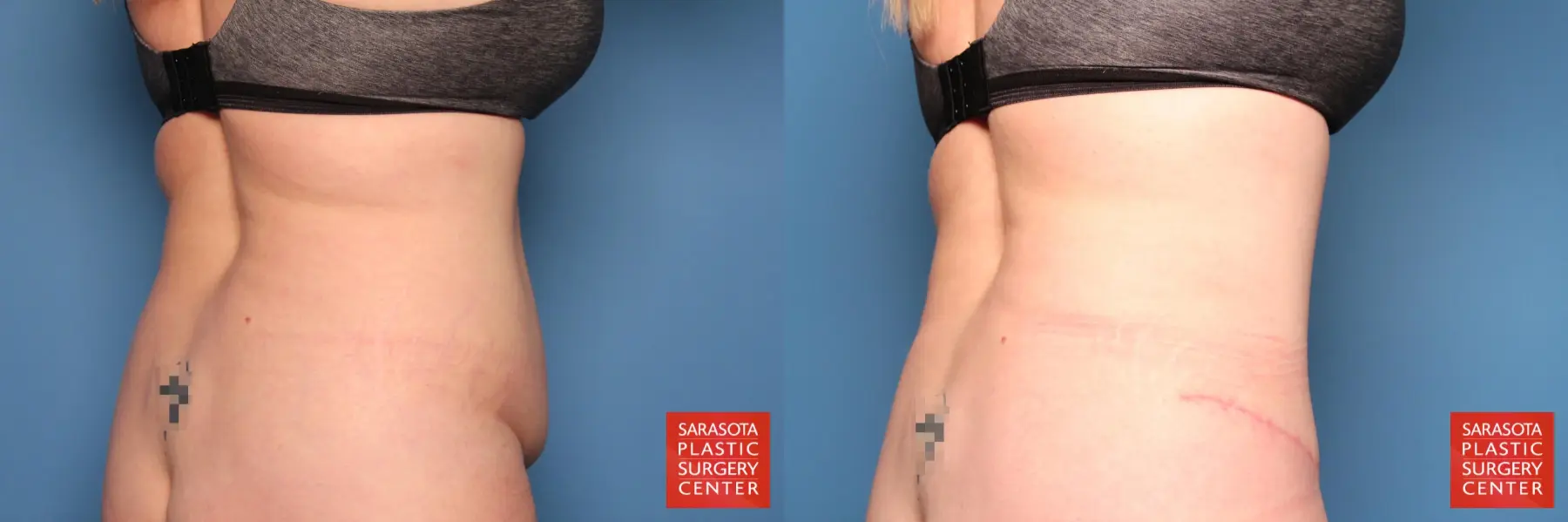 Tummy Tuck: Patient 11 - Before and After 6