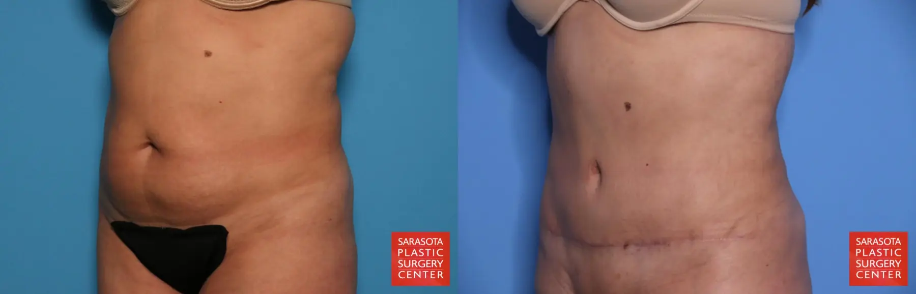 Tummy Tuck: Patient 31 - Before and After 2
