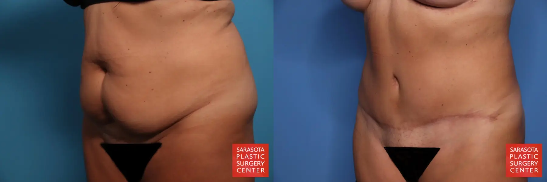 Tummy Tuck: Patient 27 - Before and After 2