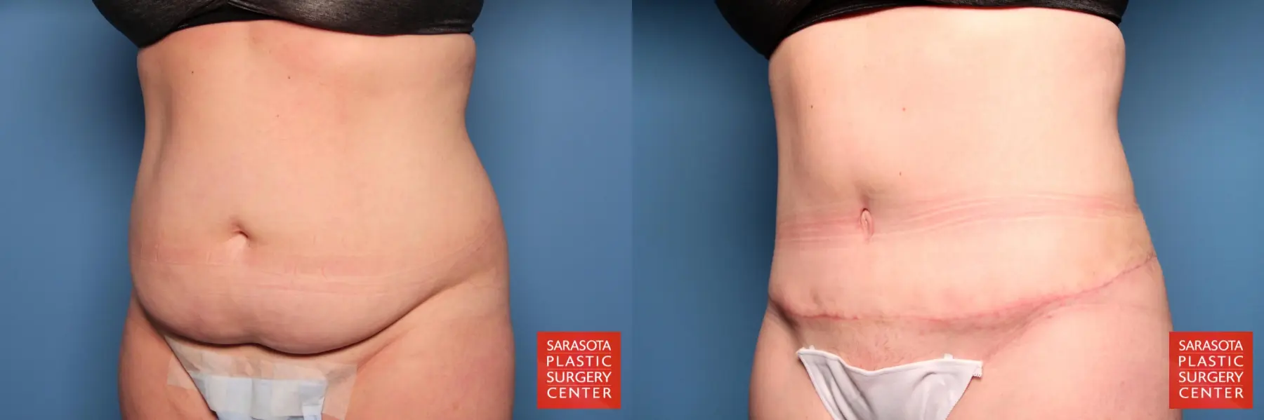 Tummy Tuck: Patient 11 - Before and After 2
