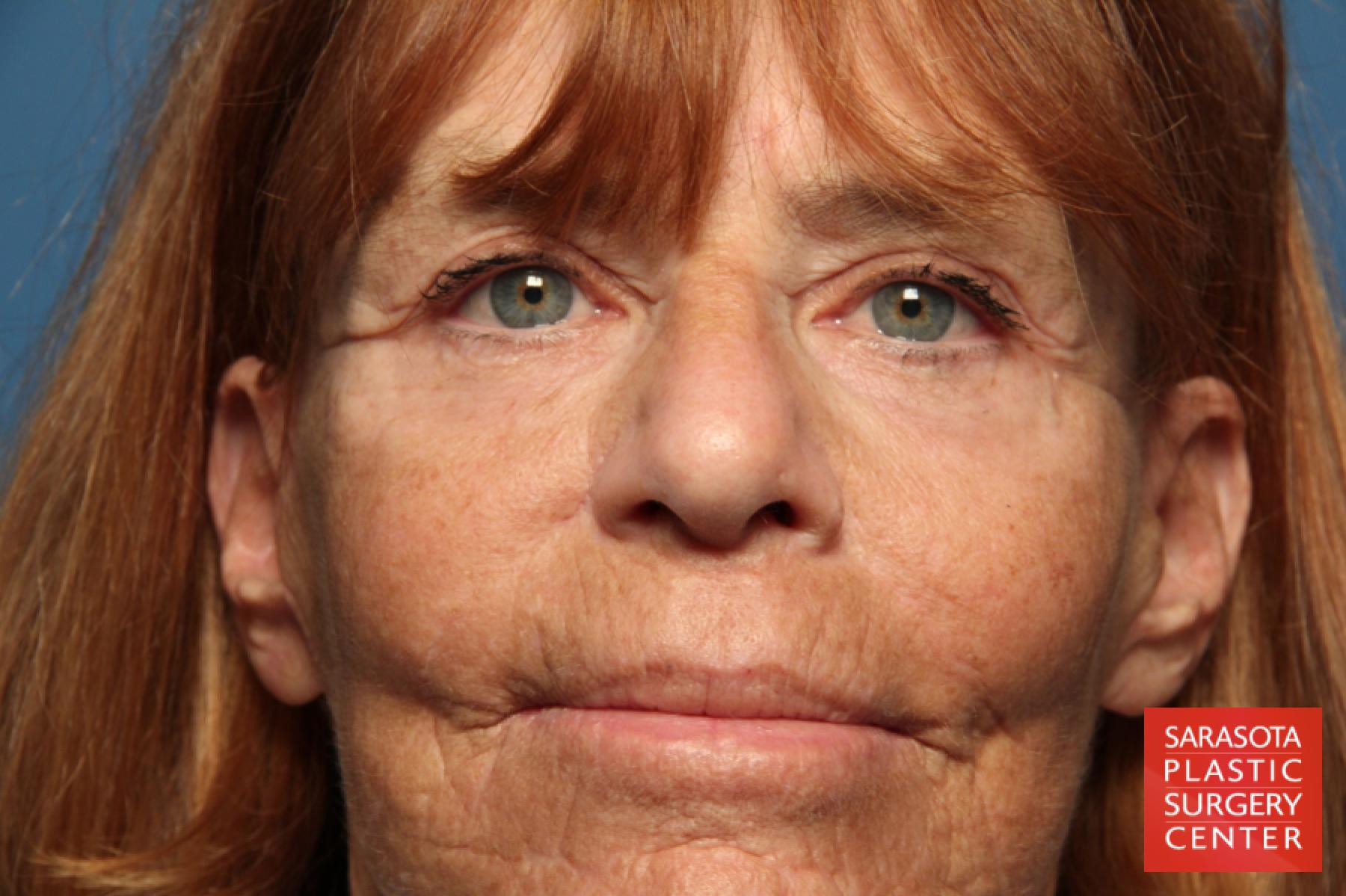 Laser Skin Resurfacing - Face: Patient 16 - After 1