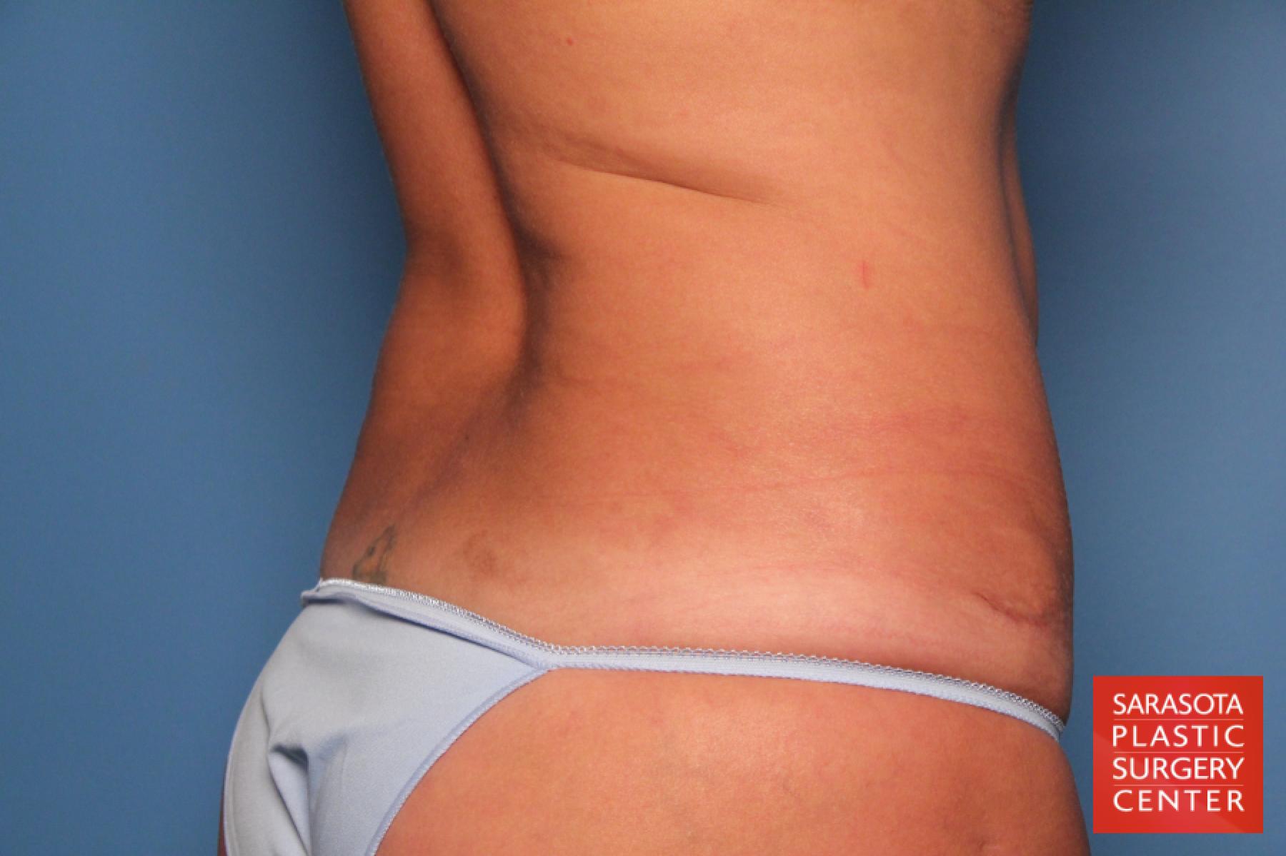 Tummy Tuck: Patient 12 - After 6