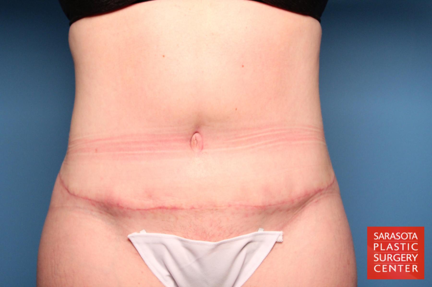 Tummy Tuck: Patient 16 - After 1