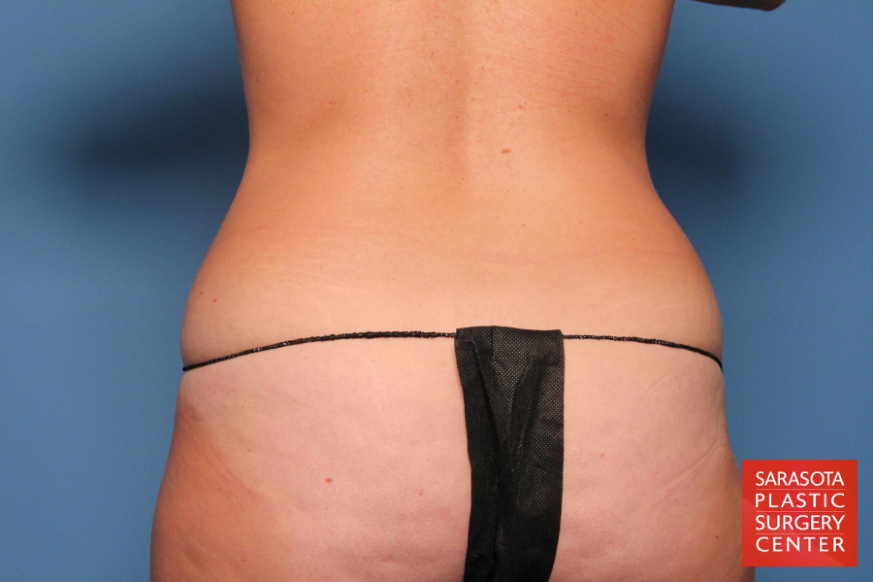 Liposuction: Patient 4 - Before and After 6