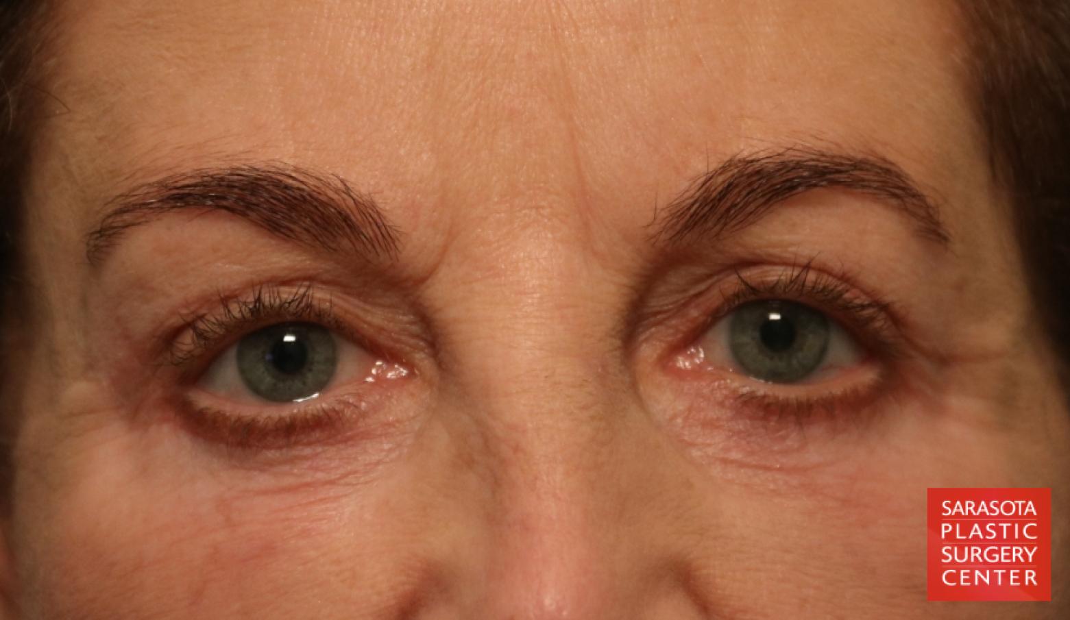 Eyelid Lift: Patient 39 - After 1