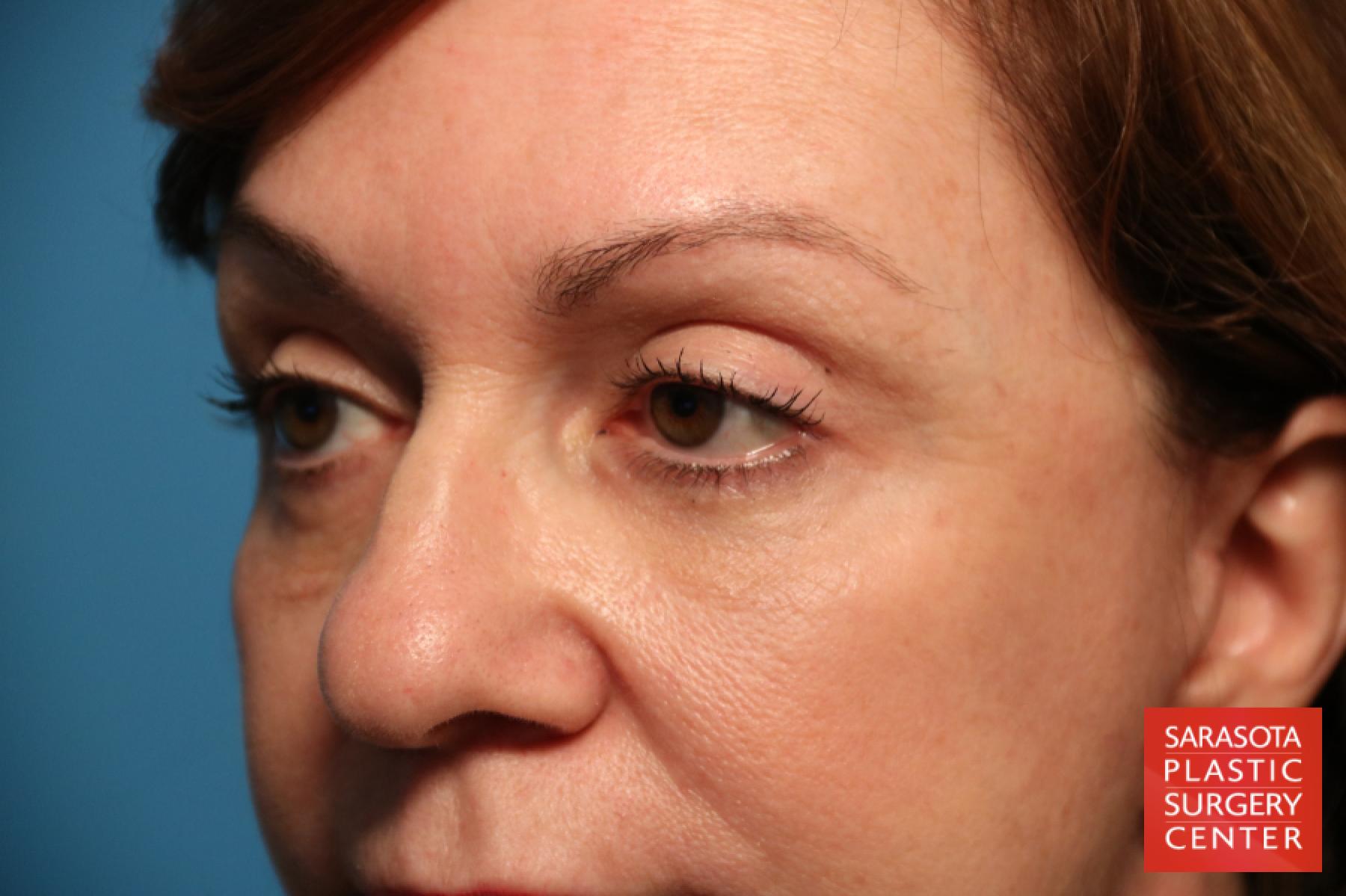 Eyelid Lift: Patient 31 - After 3