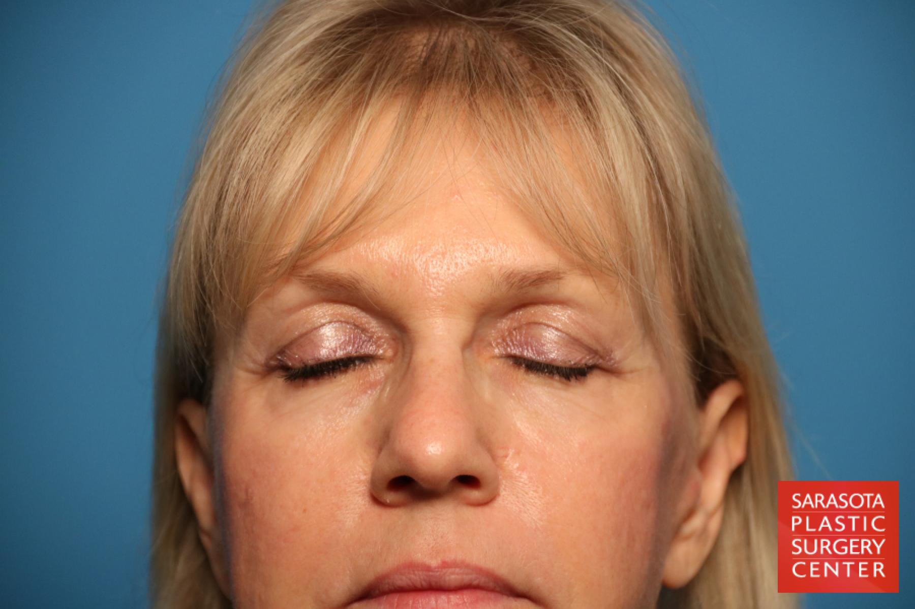 Eyelid Lift: Patient 7 - Before 2