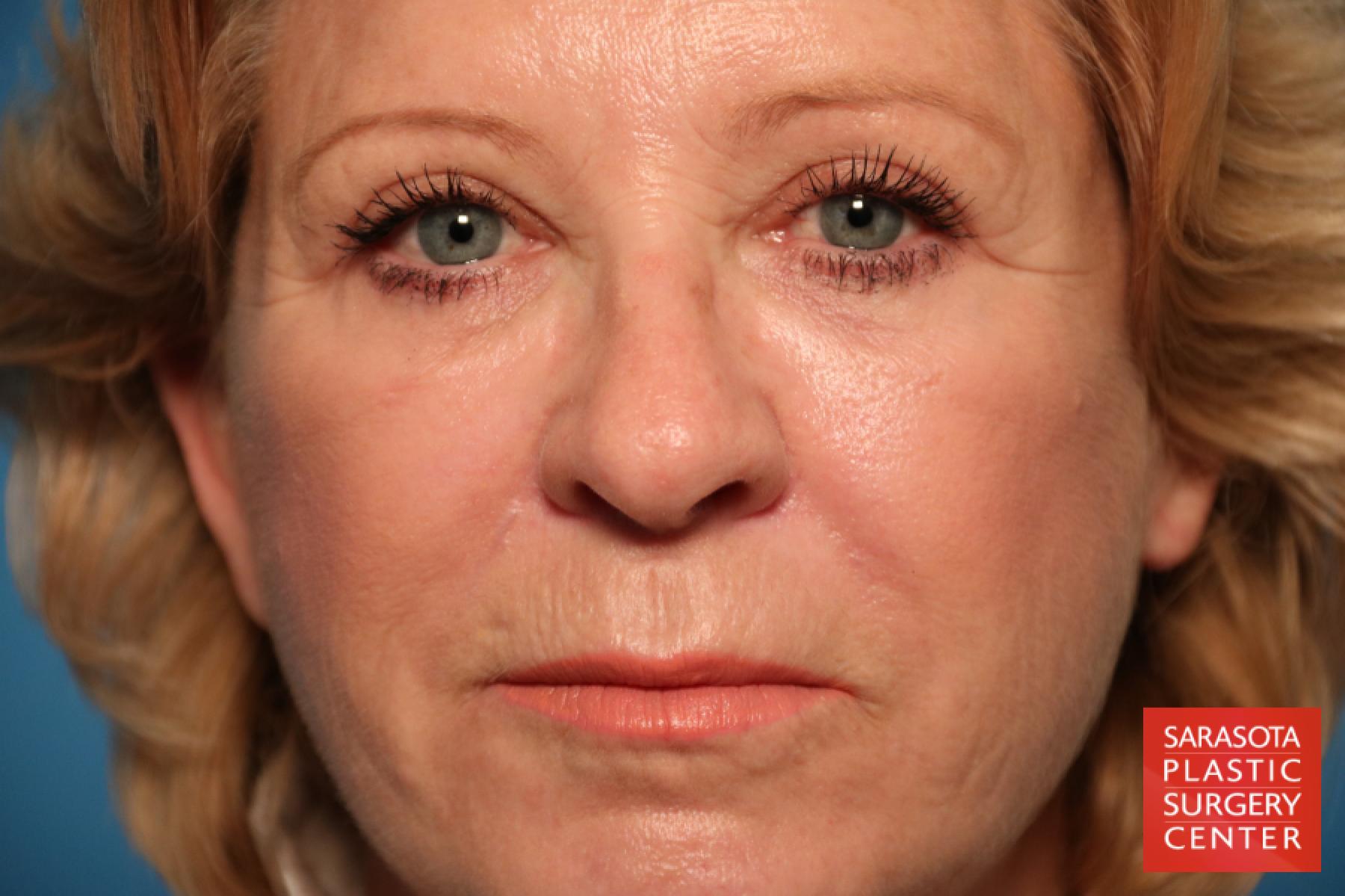 Laser Skin Resurfacing - Face: Patient 10 - After  
