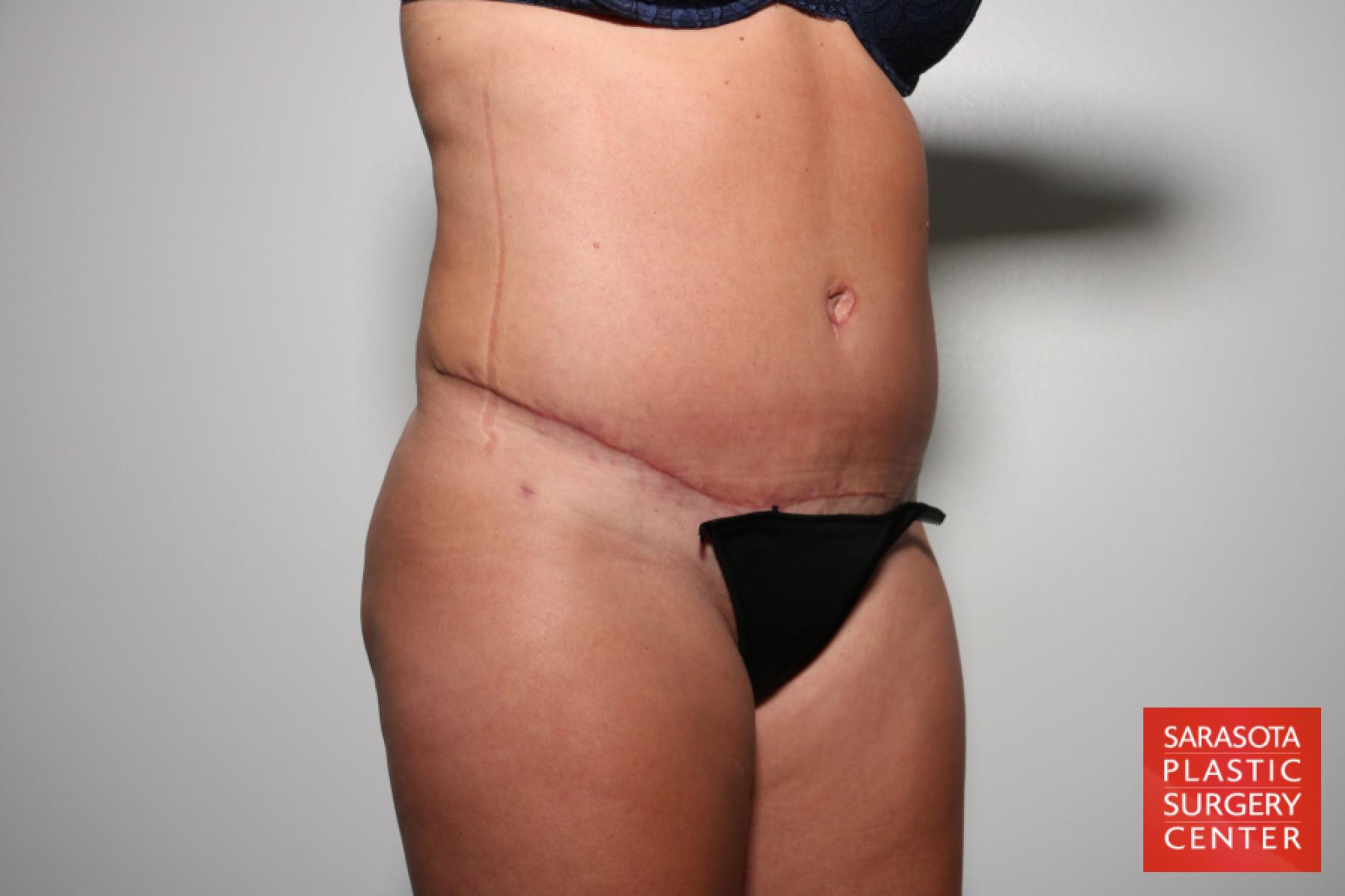 Tummy Tuck: Patient 24 - After 2
