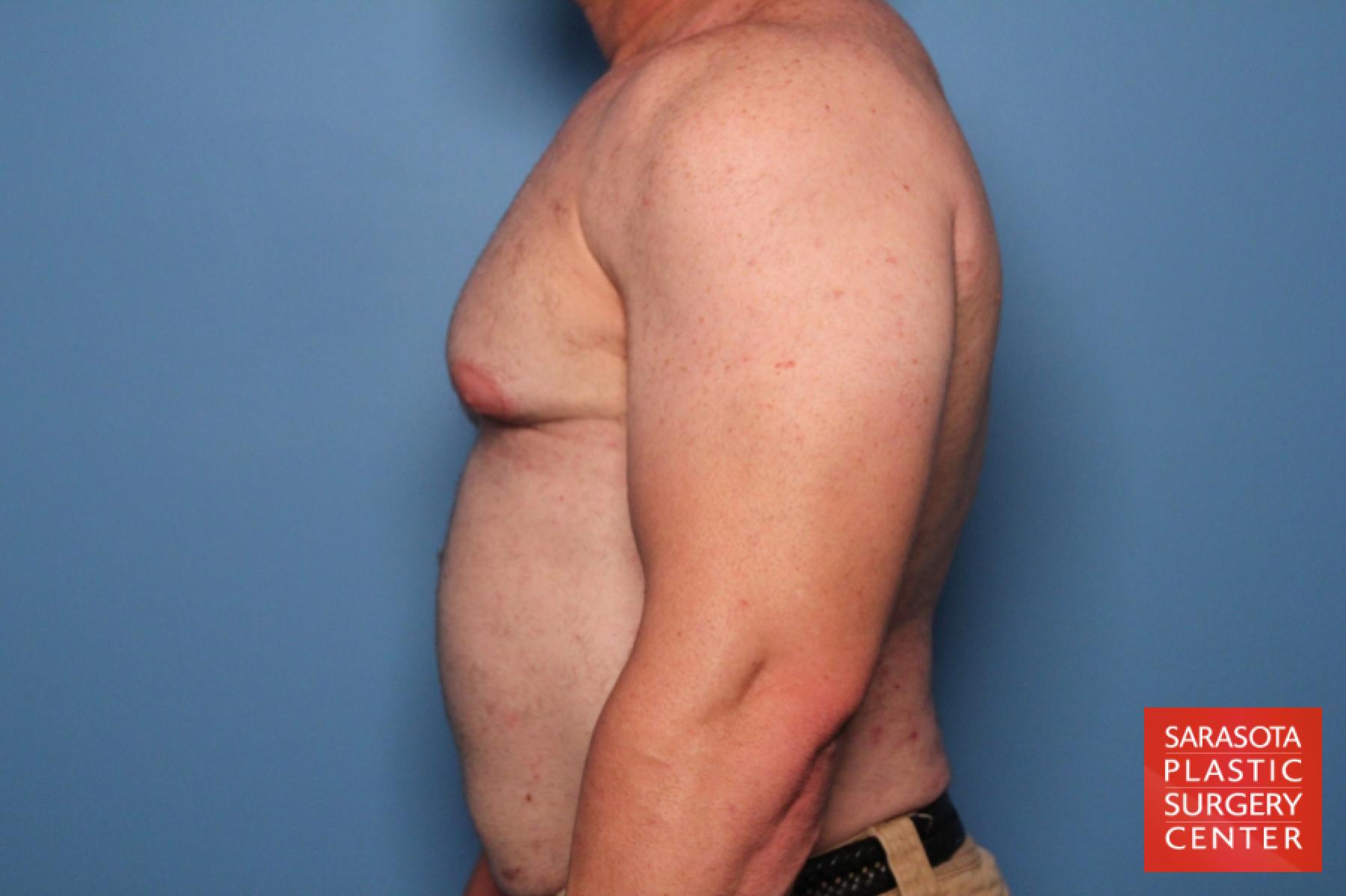 Gynecomastia: Patient 2 - Before and After 3