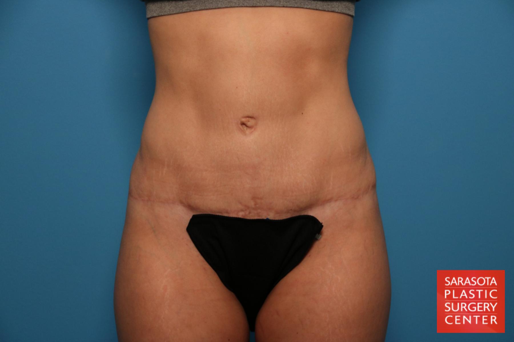 Tummy Tuck: Patient 7 - After 1
