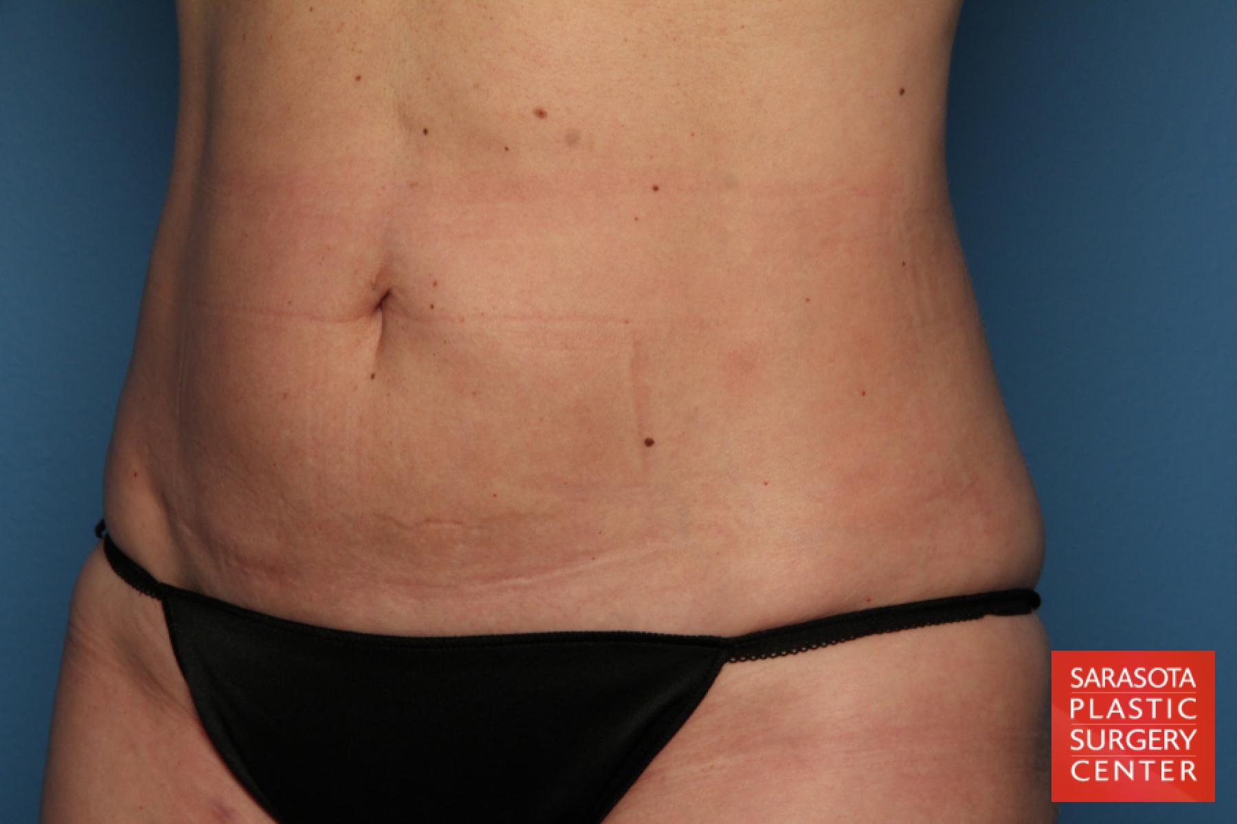 Liposuction: Patient 8 - After 2